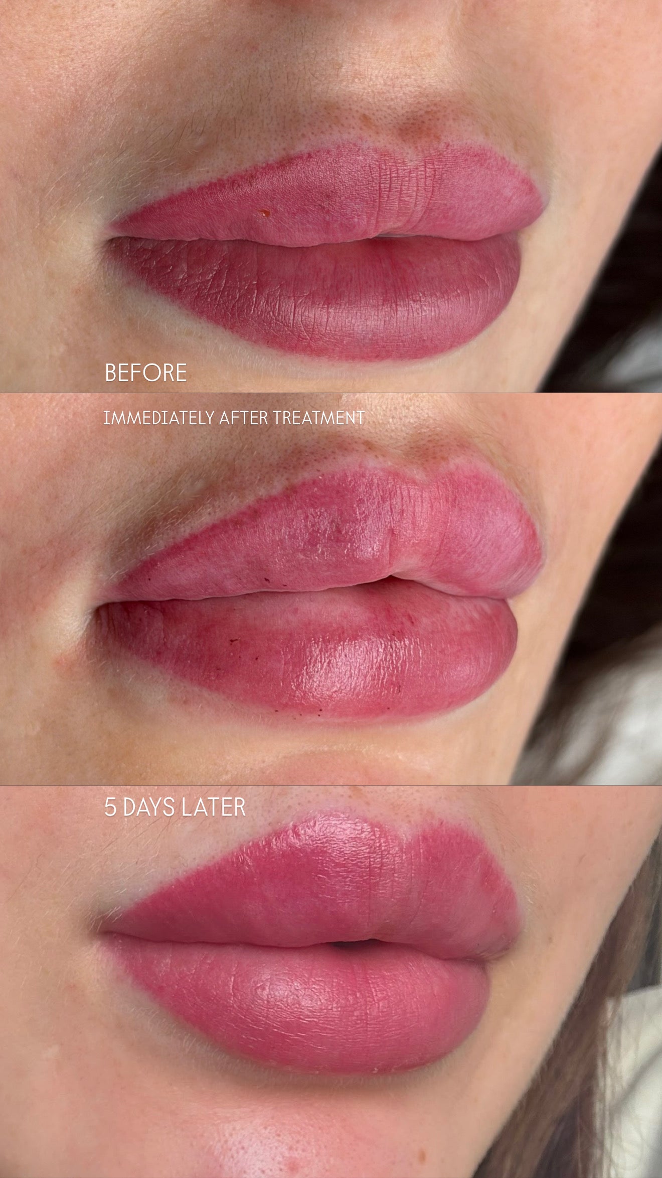 Three close-up panels of lips showing a cosmetic treatment result, labeled BEFORE, IMMEDIATELY AFTER TREATMENT, and 5 DAYS LATER.