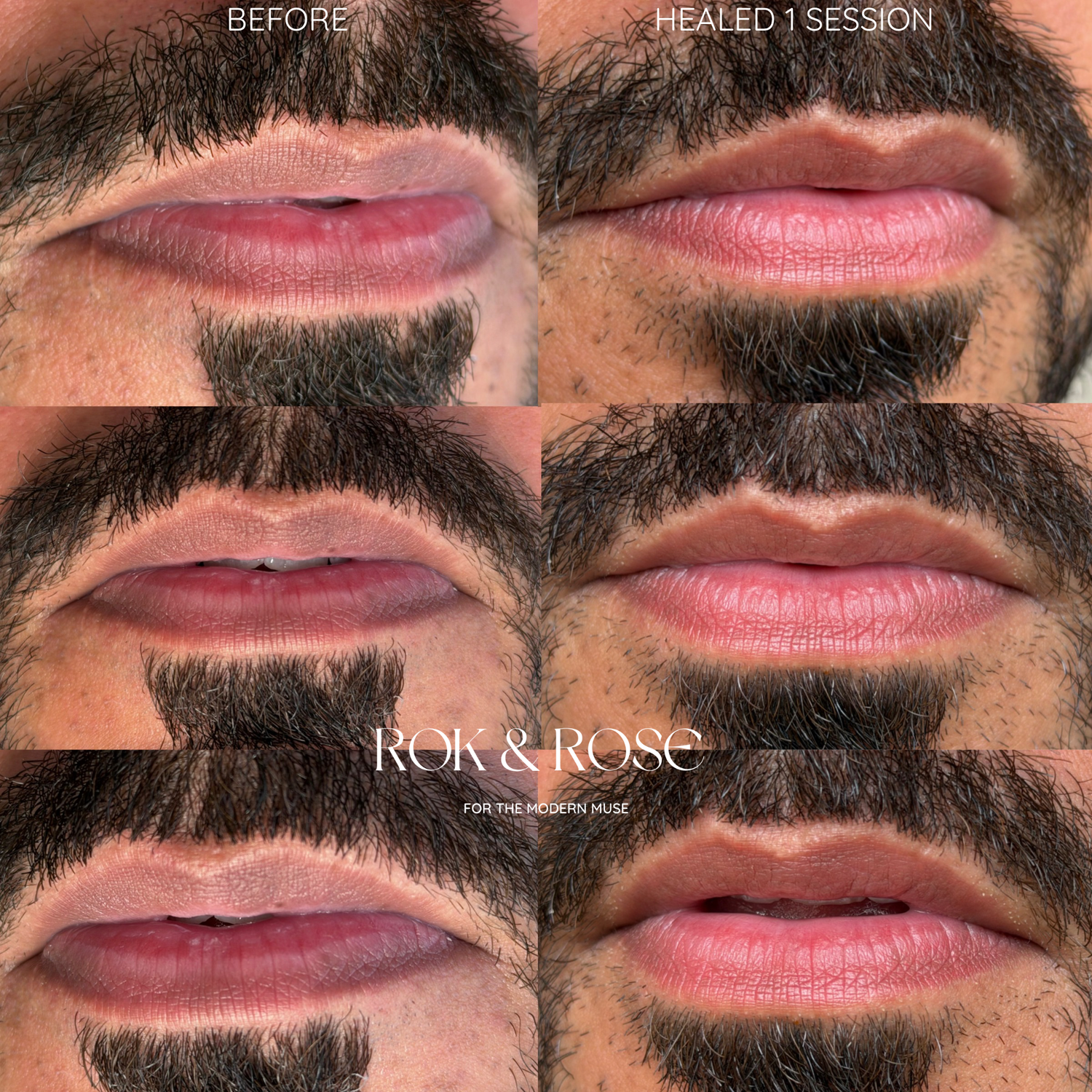 Six-panel before-and-after comparison collage showing a man's lips and mustache area, with the top row labeled 'BEFORE' and the right panel labeled 'HEALED 1 SESSION'. The center features the visible brand text 'ROK & ROSE FOR THE HUSBAND OF MISE'.